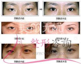 韩式<a href=http://www.washiqing.com/listinfo-724-0.html target=_blank class=infotextkey>双眼皮</a>独具一格优势 专家超超超强力强烈推荐