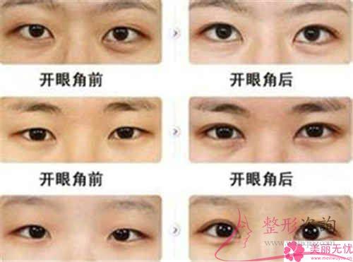 不同的6大<a href=http://www.washiqing.com/listinfo-711-0.html target=_blank class=infotextkey>开眼角</a>手术的优点