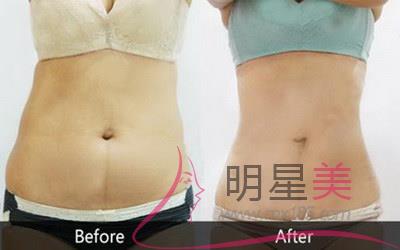 腰腹<a href=http://www.washiqing.com/listinfo-685-0.html target=_blank class=infotextkey>吸脂</a>恢复期特别痒脱皮