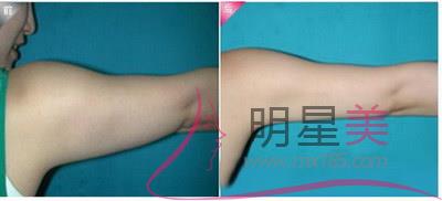 手臂<a href=http://www.washiqing.com/listinfo-685-0.html target=_blank class=infotextkey>吸脂</a>600毫升多吗