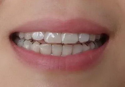 根管治疗后牙齿的寿命不做冠