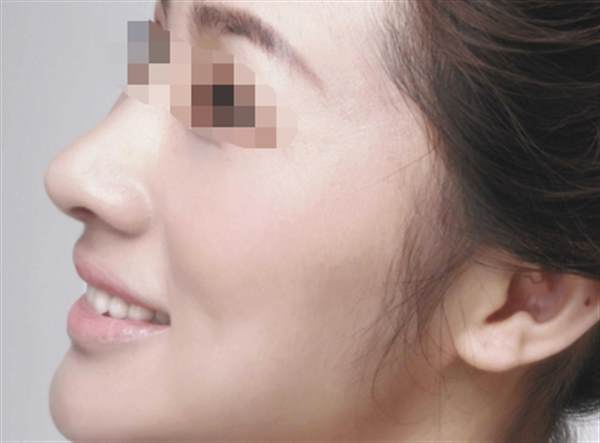 自体脂肪<a href=http://www.washiqing.com/listinfo-737-0.html target=_blank class=infotextkey>隆鼻</a>恢复期多久