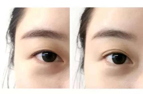 肿眼泡适合选择哪种<a href=http://www.washiqing.com/listinfo-724-0.html target=_blank class=infotextkey>双眼皮</a>贴？