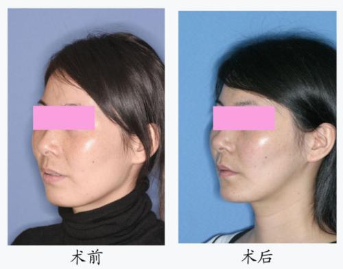<a href=http://www.washiqing.com/listinfo-632-0.html target=_blank class=infotextkey>正颌</a>手术后脸型改变大吗