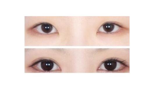 割<a href=http://www.washiqing.com/listinfo-724-0.html target=_blank class=infotextkey>双眼皮</a>手术的效果好吗