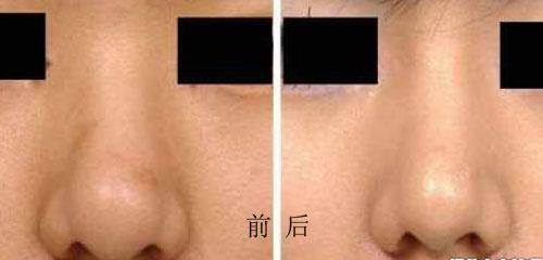 鼻子缩小术一般多少钱