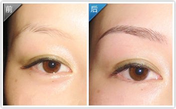 激光<a href=http://www.washiqing.com/listinfo-658-0.html target=_blank class=infotextkey>洗眉</a>太深会留疤吗