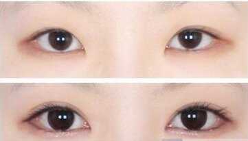 韩式<a href=http://www.washiqing.com/listinfo-711-0.html target=_blank class=infotextkey>开眼角</a>多久恢复