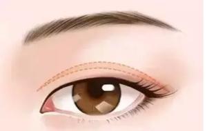 <a href=http://www.washiqing.com/listinfo-717-0.html target=_blank class=infotextkey>上睑下垂矫正</a>手术需要注意什么？