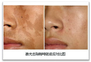 氢醌霜<a href=http://www.washiqing.com/listinfo-795-0.html target=_blank class=infotextkey>祛斑</a>的危害