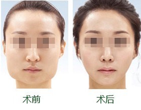 下颌骨手术后遗症