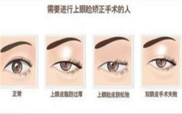 上脸下垂的矫正过程