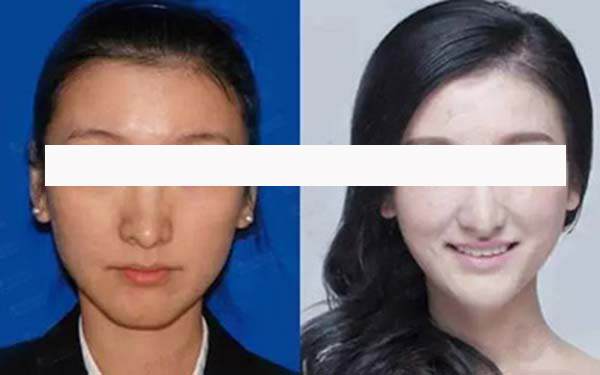 如何去掉双下巴