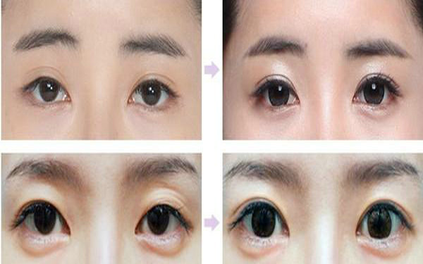 纳米<a href=http://www.washiqing.com/listinfo-724-0.html target=_blank class=infotextkey>双眼皮</a>多久能化妆?