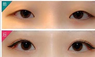 埋线法割<a href=http://www.washiqing.com/listinfo-724-0.html target=_blank class=infotextkey>双眼皮</a>原理