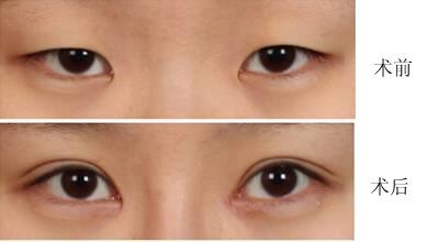 韩美<a href=http://www.washiqing.com/listinfo-724-0.html target=_blank class=infotextkey>双眼皮</a>多少钱