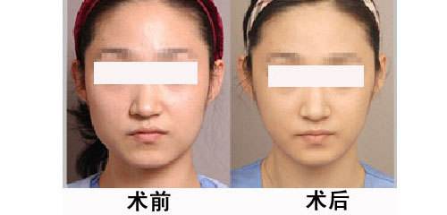 学生<a href=http://www.washiqing.com/listinfo-631-0.html target=_blank class=infotextkey>瘦脸</a>的较好方法